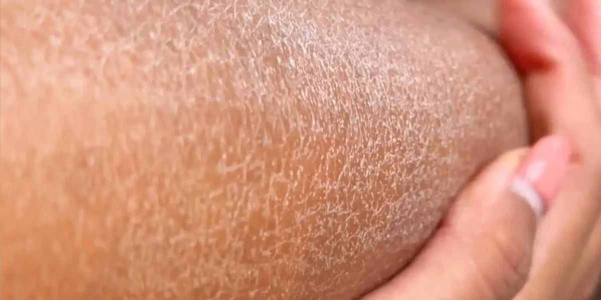 Haut vor der Anwendung des Kōji Peeling-Handtuchs – trocken und fahl